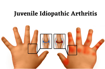 Juvenile Idiopathic Arthritis