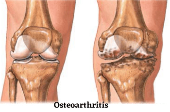 Osteoarthritis