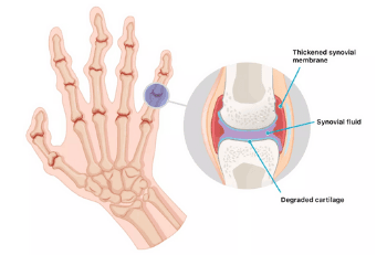 Rheumatoid Arthritis