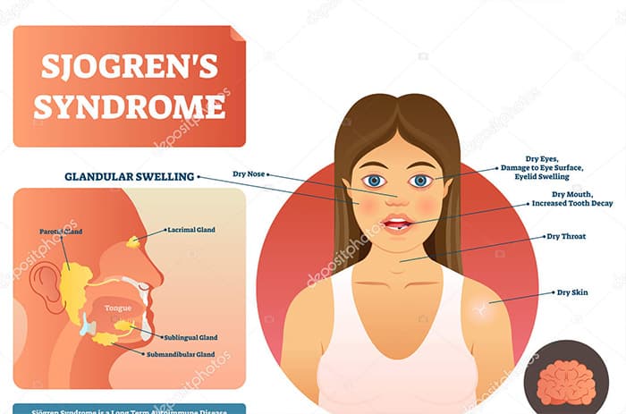 Sjogren's Syndrome